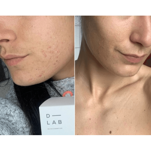 Peau-Parfaite Proti Nedokonalostem Pleti D-LAB